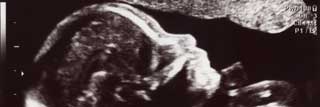 An ultrasound of a baby in the womb